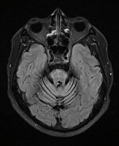 MSA MRI Cross sign