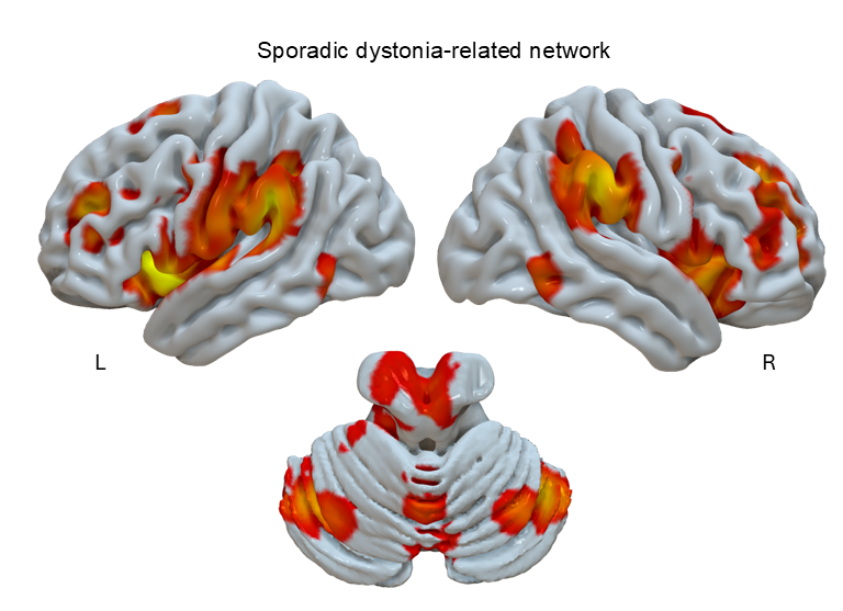 Sporadic Dystonia Related Network
