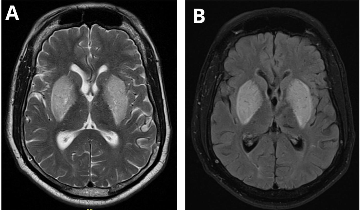 Lentiform Fork Sign on brain MRI (T2/FLAIR)