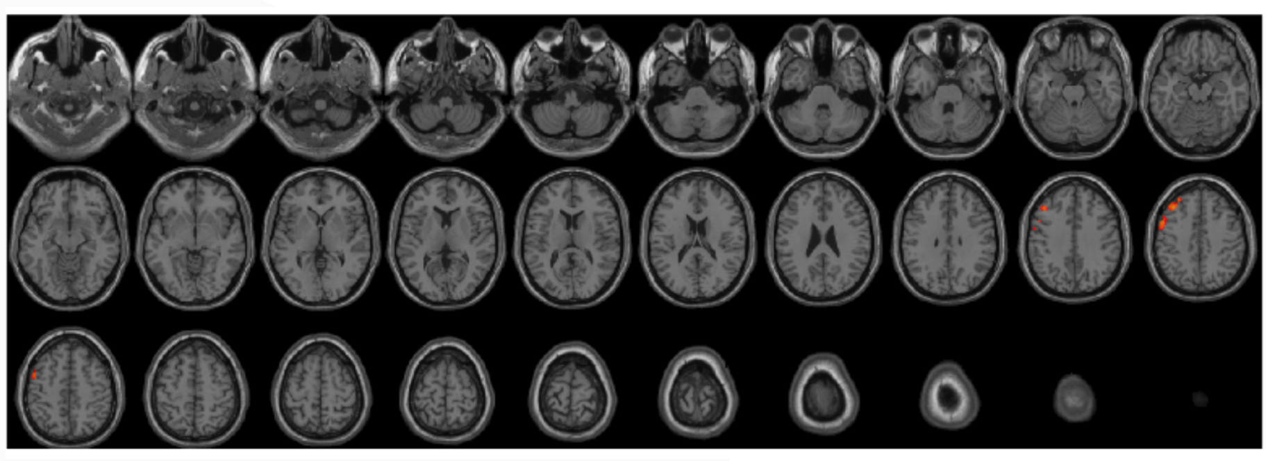 Results of regional homogeneity between PD and HC