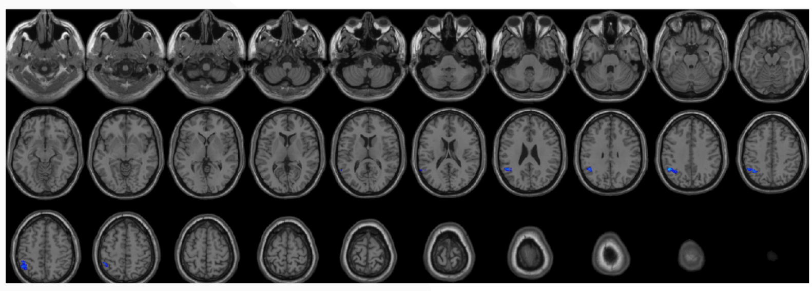 Seed based zFC of middle frontal gyrus