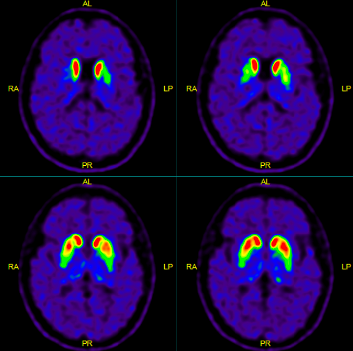 Brain dopamine transporter PET/CT imaging.