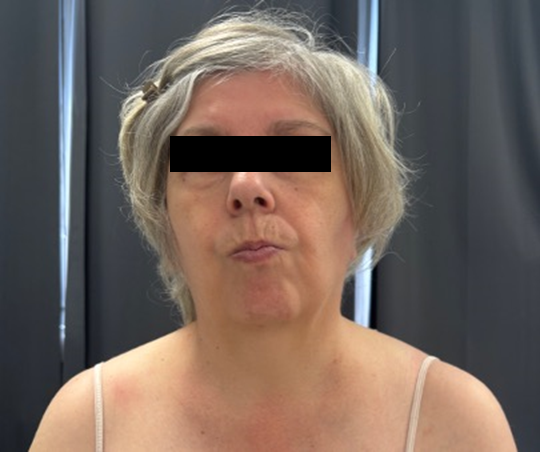 Lateral shift with platysma spasm.