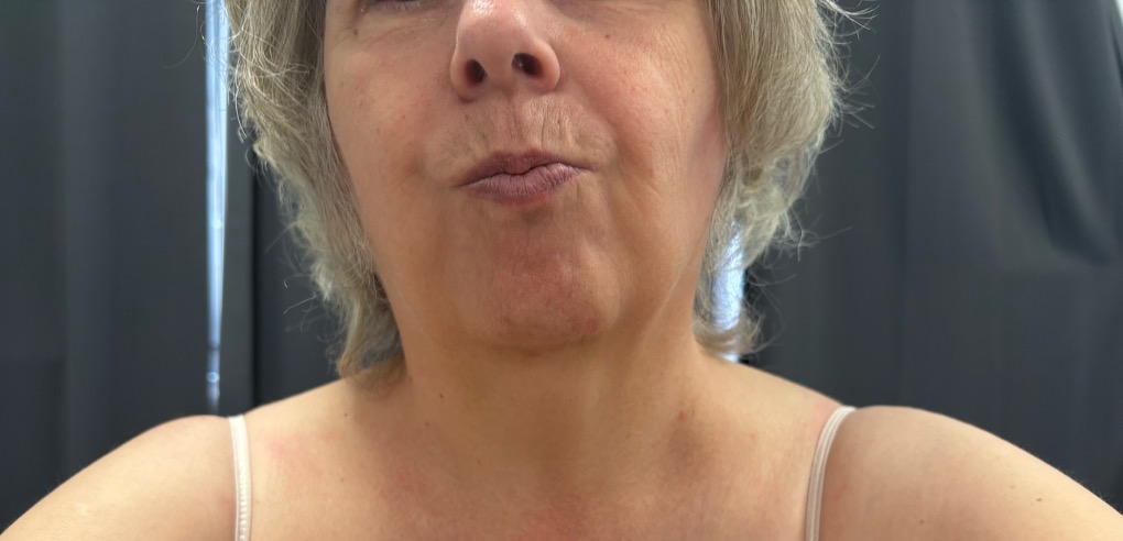 Oromandibular dystonia.