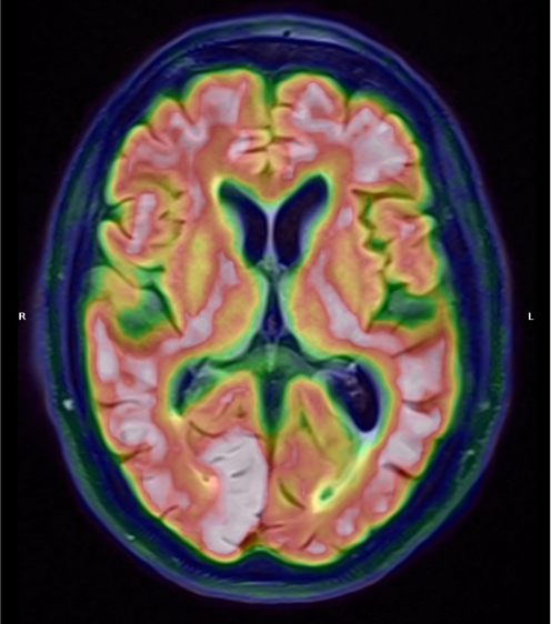 Vizamyl PET/CT.