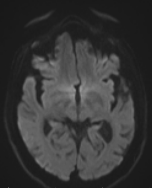Bilateral temporal brain atrophy.