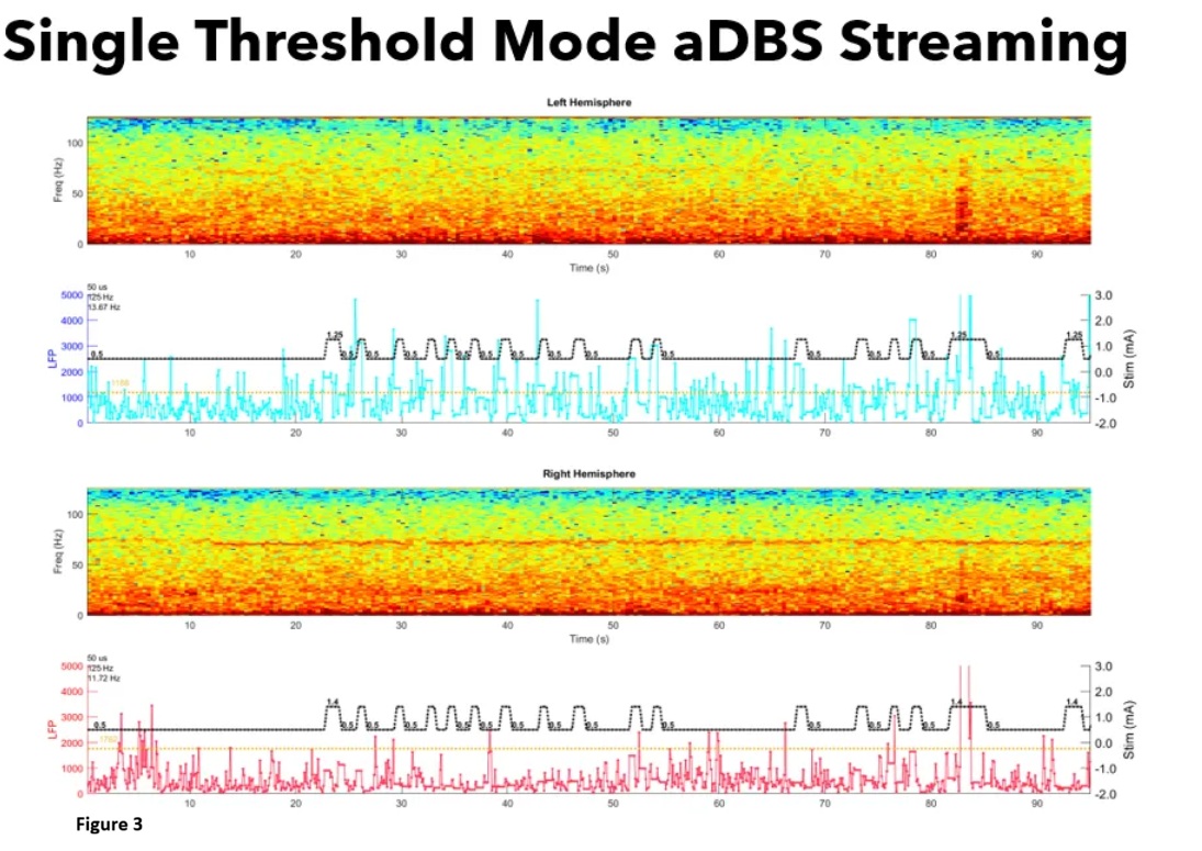 Adaptive DBS Modulation from STN LFP Activity