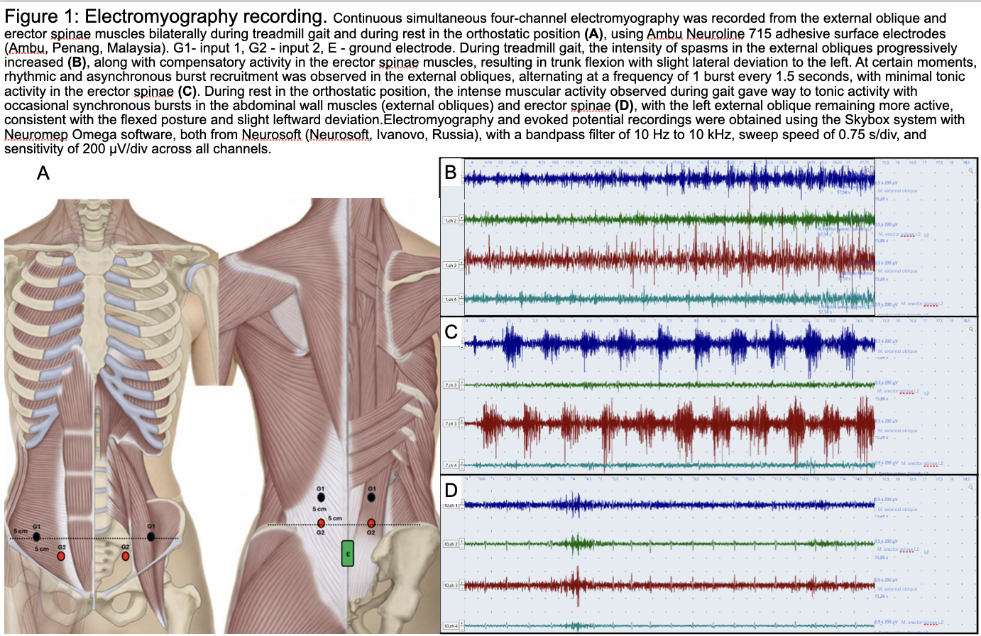Figure 1: Electromyography recording