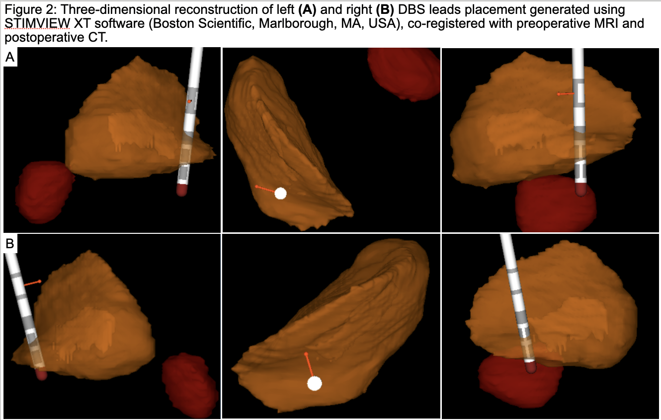 Figure 2: DBS leads reconstruction