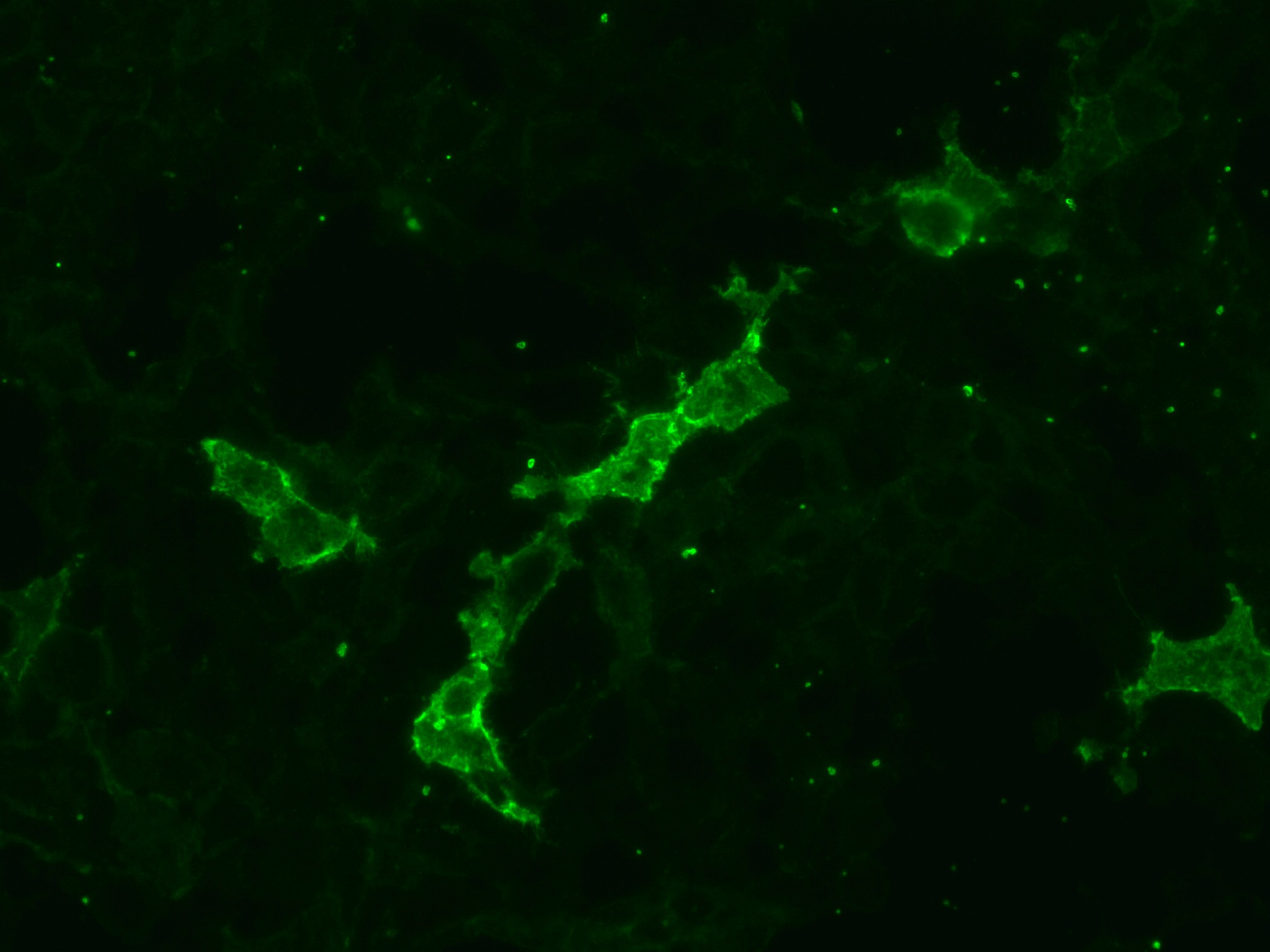 Anti-LGI1 Ab