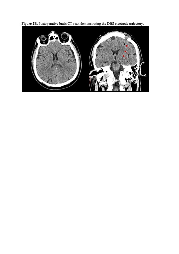 Postoperative brain CT DBS electrode trajectory.