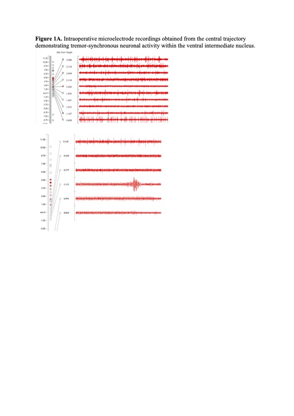 VIM Intraoperative microelectrode recordings