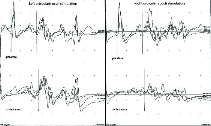 Impaired blink reflex habituation
