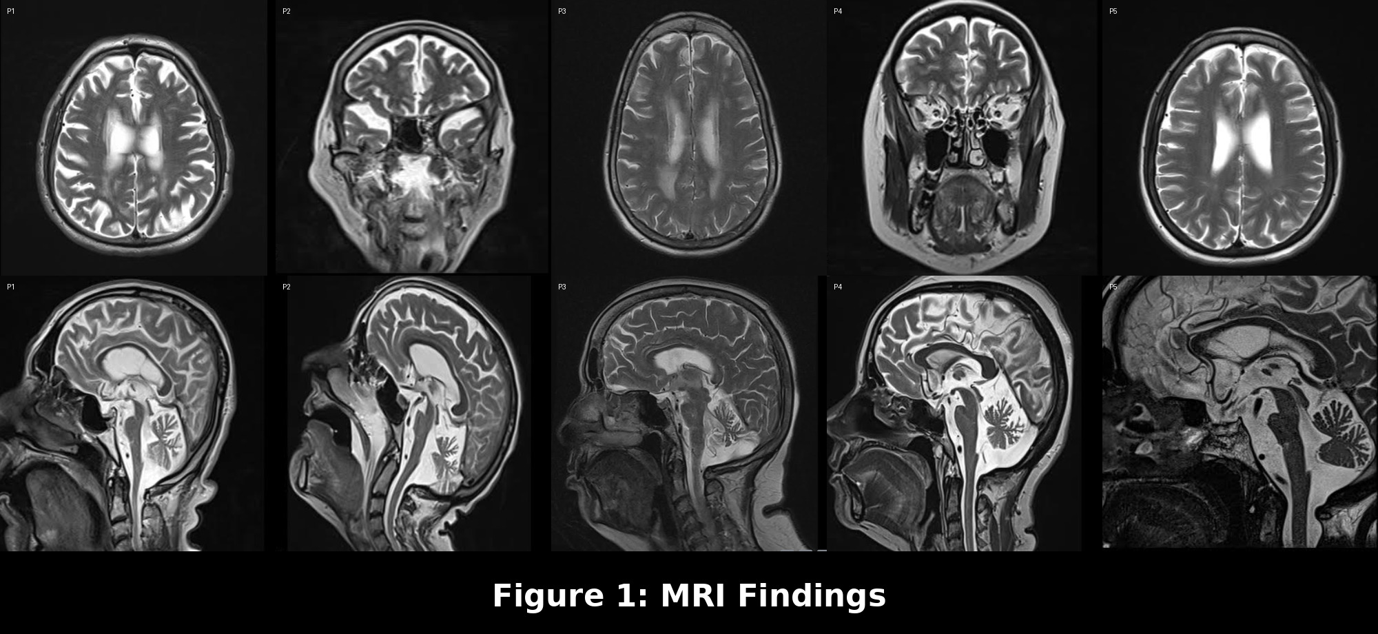 MRI Findings