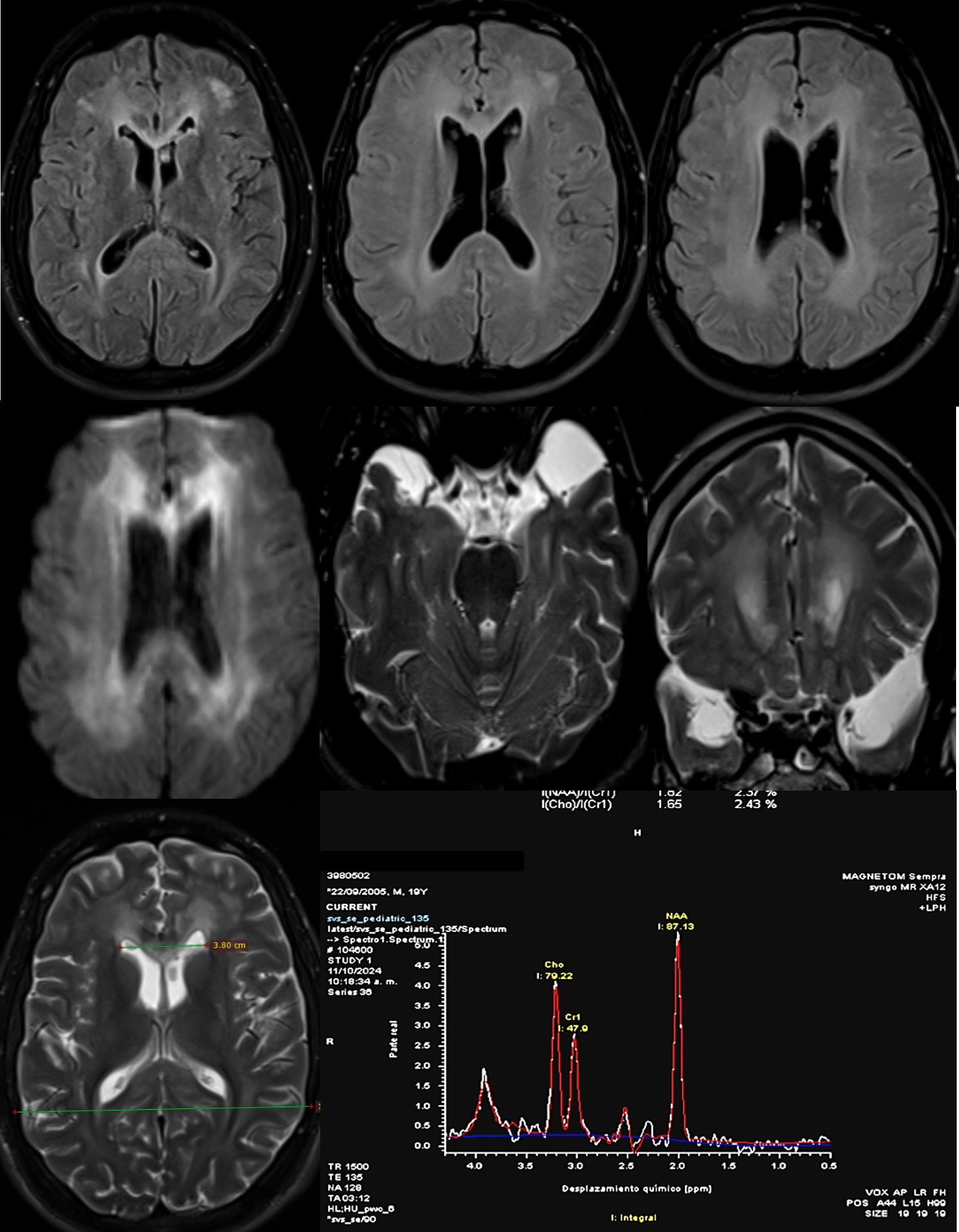 Brain MRI /MRS