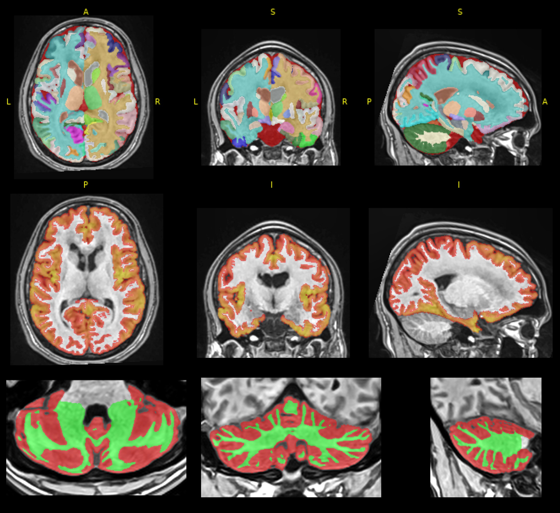 Brain volumetry performed using volBrain