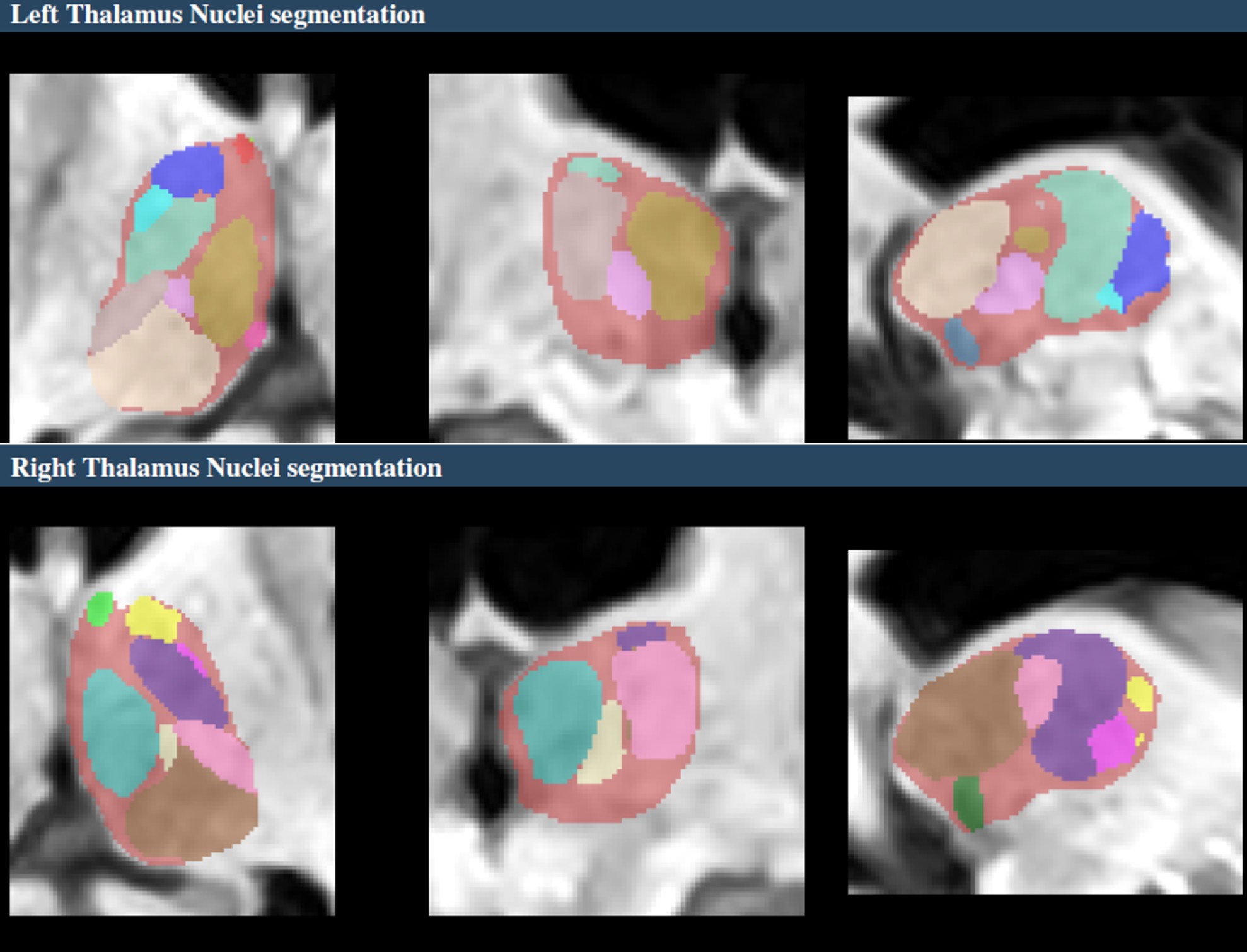 Thalamus nuclei segmentation
