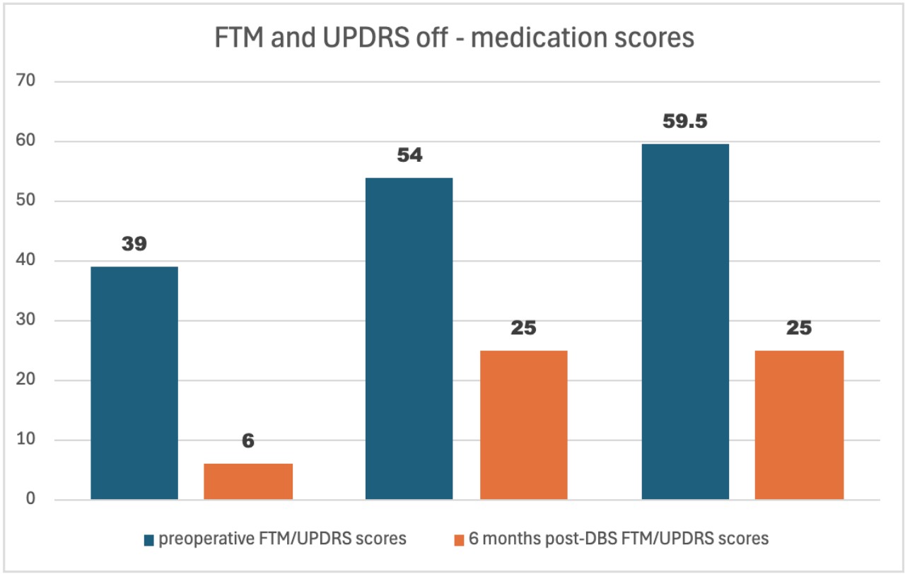 Pre- and Postoperative FTM and UPDRS-OFF scores