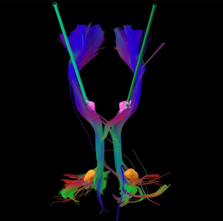 Patient-specific Diffusion Tractography