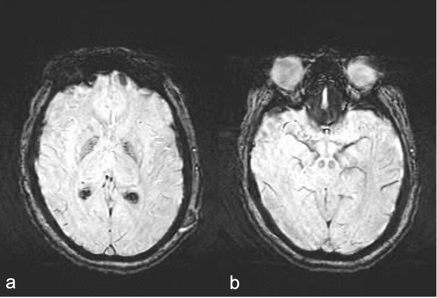 SWI MRI: pallidal mineralization,SN/RN signal
