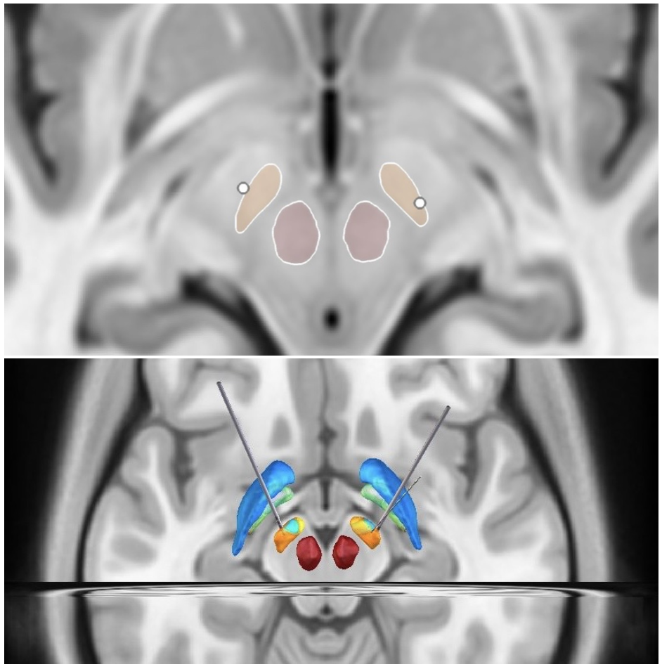 Figure 1. Representative Lead-DBS reconstruction