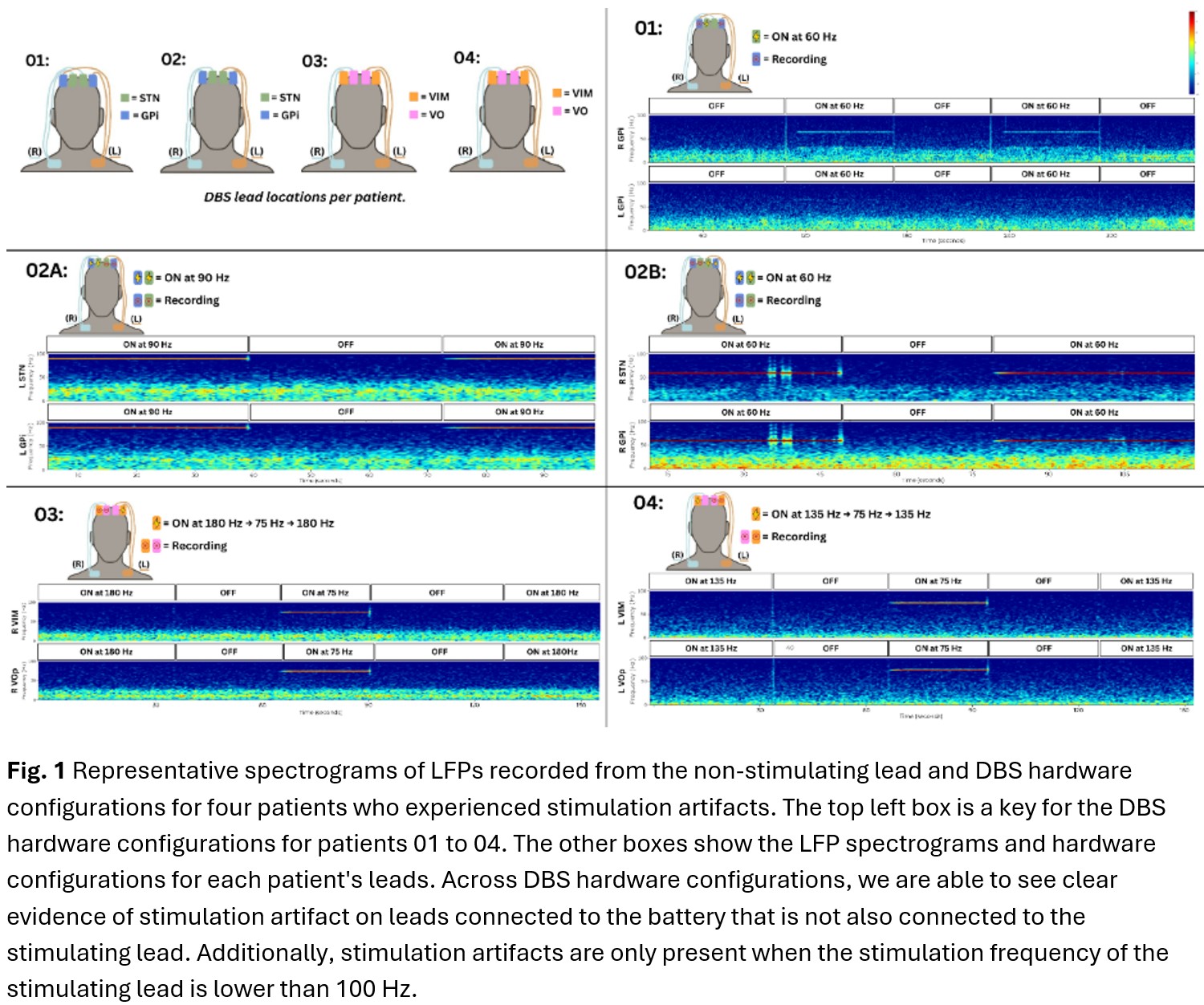Figure 1 - Stimulation Artifact in Four Patients