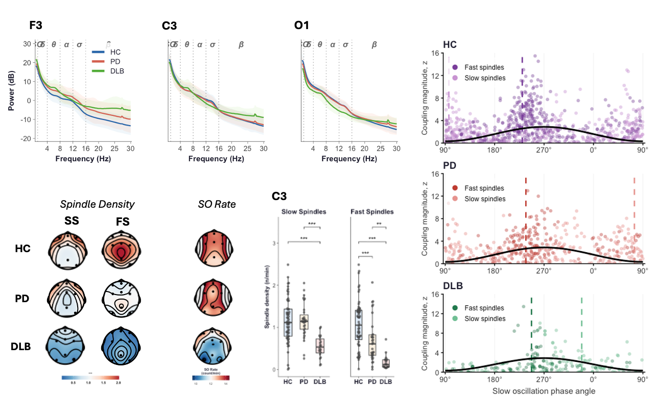 NREM EEG Alterations During NREM Sleep in LBD
