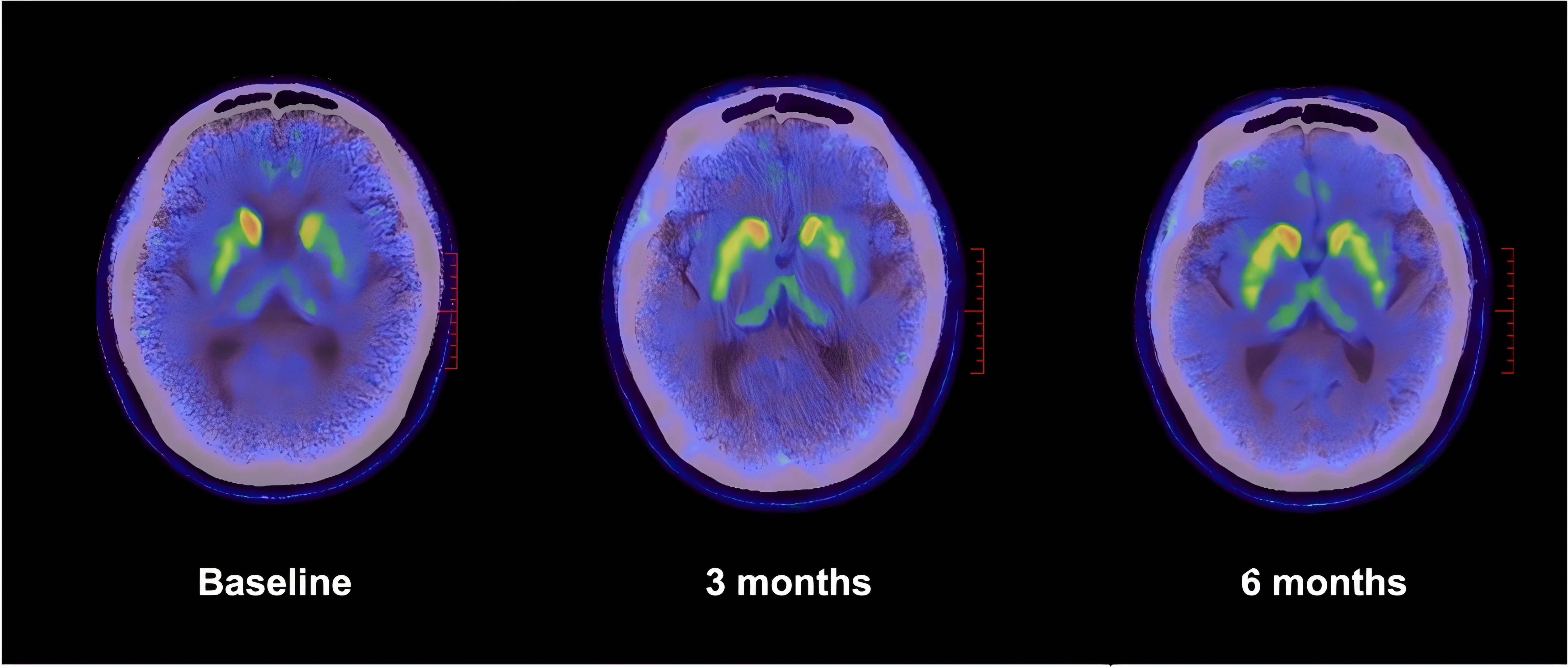 Figure 4 18F-DOPA PET/CT of Subject 1