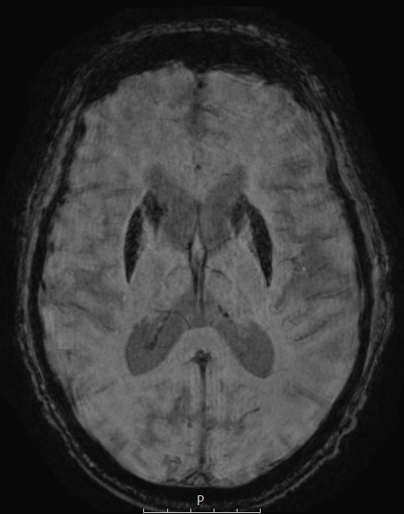 SWI showing iron deposition in basal ganglia.