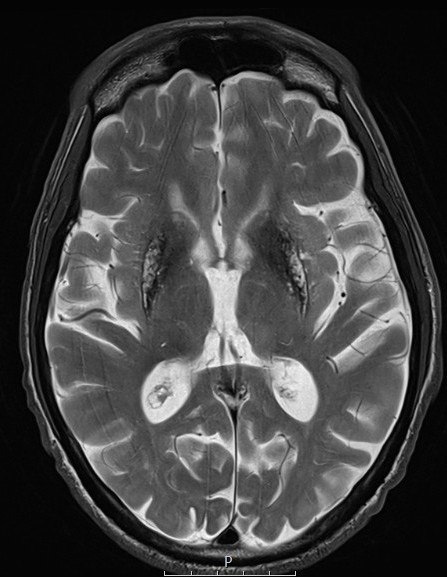 T2 Hypointensities in bilateral basal ganglia.