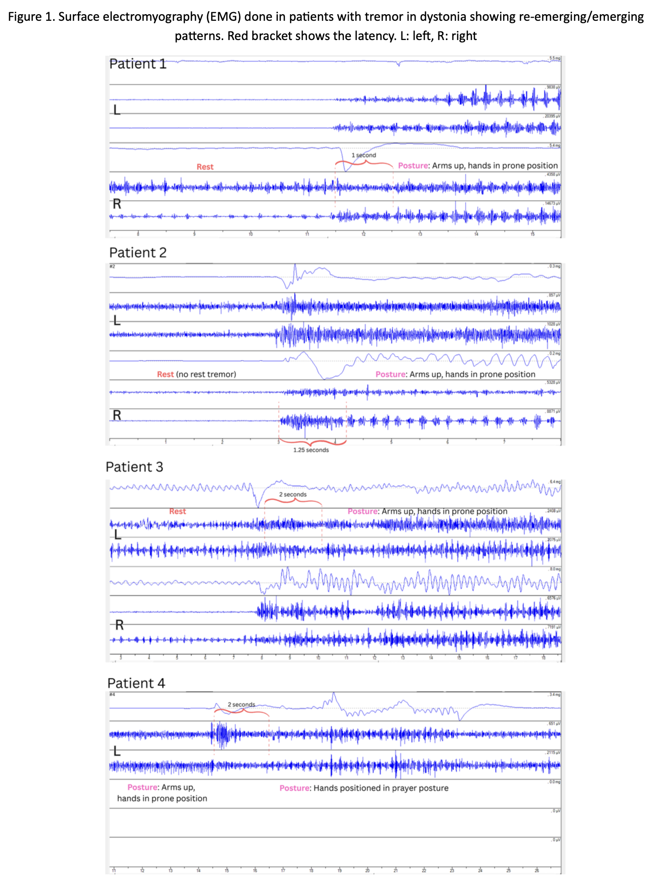 Figure 2. Surface EMG: re-emerging/emerging
