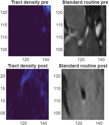 Strong local of the TD near the electrode, case 1