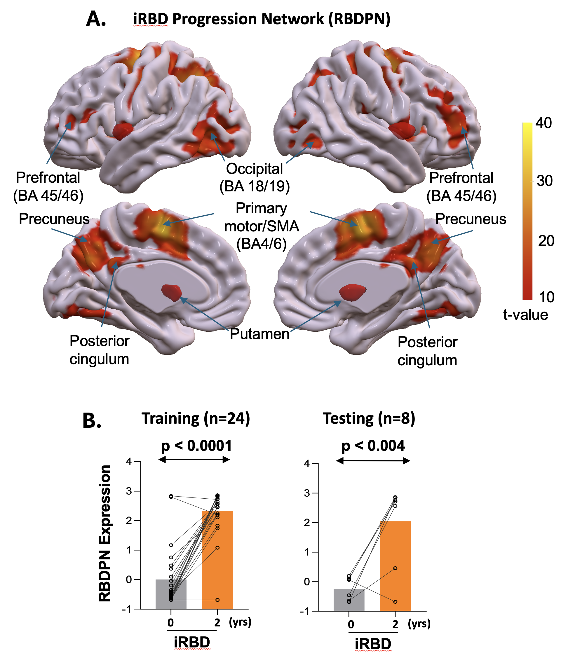 iRBD progression network (RBDPN)