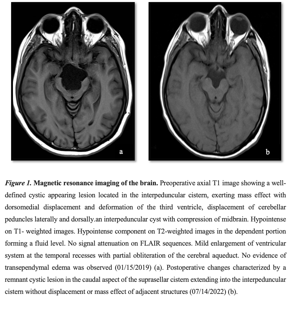Giant interpeduncular cyst pre and postoperative